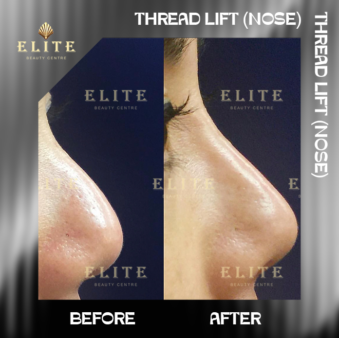 NOSE THREAD LIFT